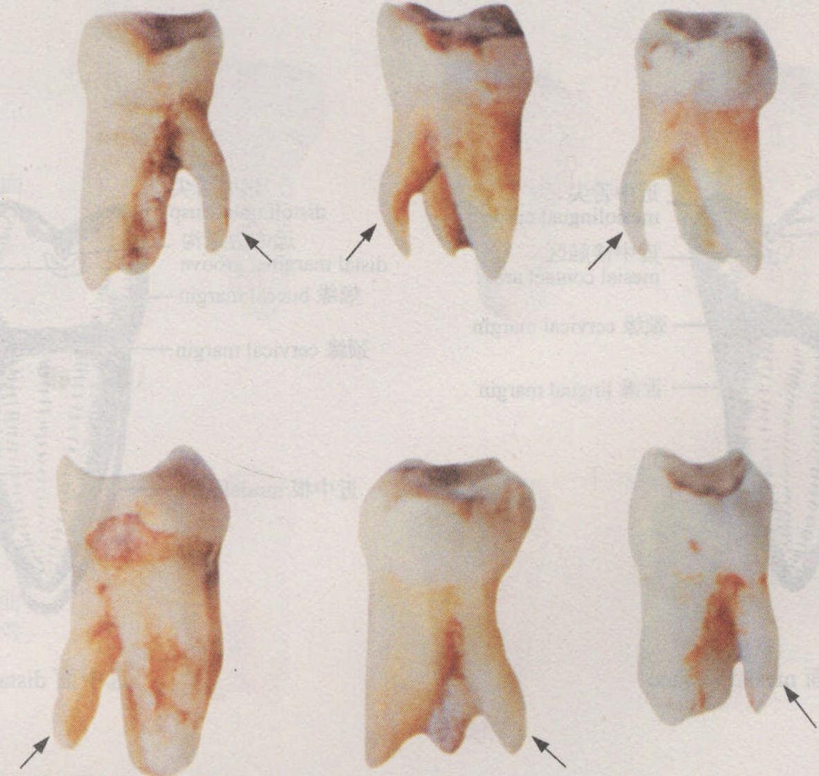 牙菌斑图片牙结石-千图网